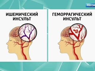 Доктор Беленков о том, как происходит инфаркт и настигает инсульт