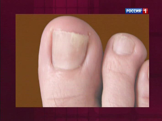 Эффективный лак против грибка ногтей