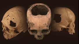 Древние инки делали трепанацию черепа лучше медиков времён Гражданской войны в США