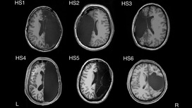 На снимках, полученных с помощью фМРТ, видны срезы мозга пациентов, перенёсших удаление полушария в детстве.