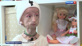 13-летняя девочка с редчайшим диагнозом "прогерия" живет в Новосибирске
