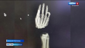 Врачи Приволжского исследовательского медицинского университета спасли отрубленную руку юноше из города Коврова