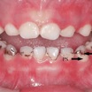 Некоторые дети страдают от сильнейшего кариеса. На снимке шесть зубов ребёнка имеют чёрные пятна.