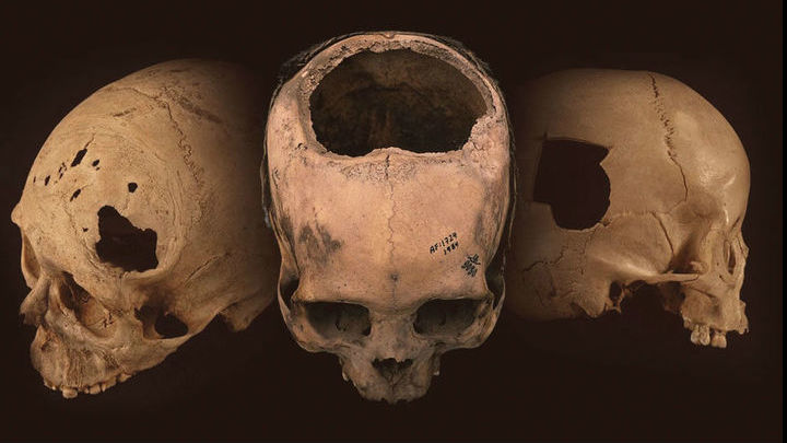 В центре изображения череп человека, жившего в Перу в 400-200 годы до нашей эры. По всей видимости, у него был перелом черепа, который лечили при помощи трепанации. Правда, спустя две недели он всё же скончался. 