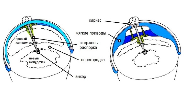 Внешние приводы ритмично сжимают сердце, а анкер манипулирует межжелудочковой перегородкой, чтобы оба отдела могли расширяться и сжиматься.