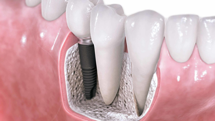 В ходе лечения корневого канала зуба могут возникнуть проблемы, связанные с попаданием в незащищённую полость патогенных бактерий.